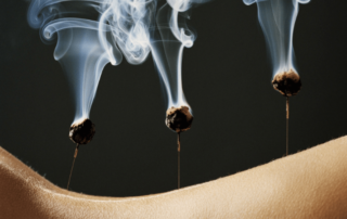 Moxibustion for breech presentation