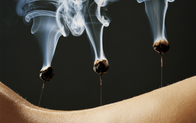 Moxibustion for breech presentation