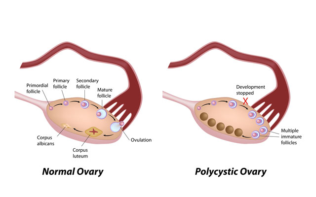 Bilateral Polycystic Ovaries Pregnancy Birth And Beyond