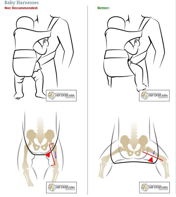 hip-dysplasia-image
