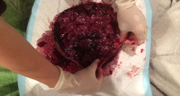 Umbilical cord