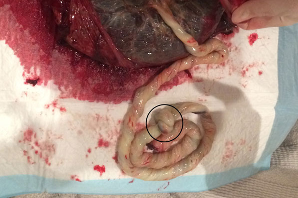 Umbilical cord