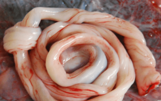 True Knot of the Umbilical Cord