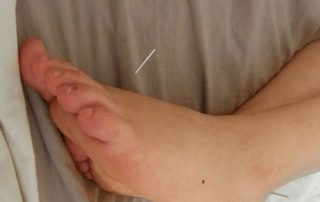 Acupuncture and Stalled Labour
