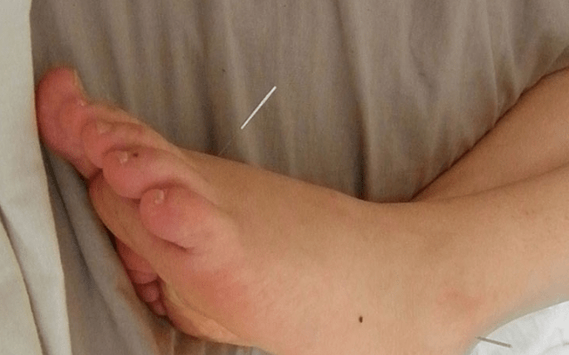 Acupuncture and Stalled Labour