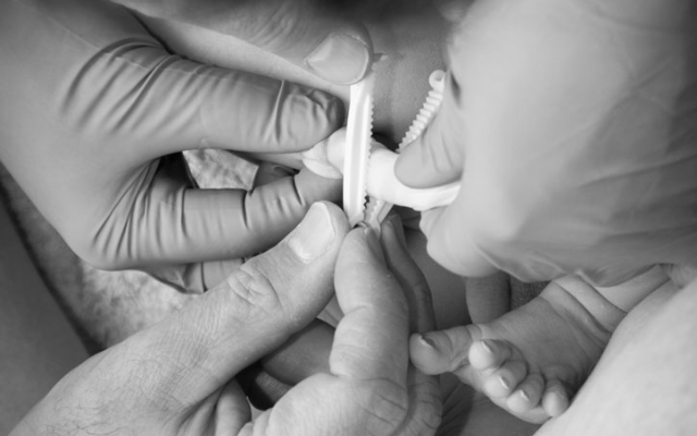 Cord Care in Newborns
