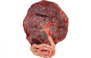 Placenta Praevia