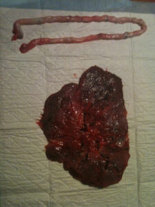 encapsulating-placenta
