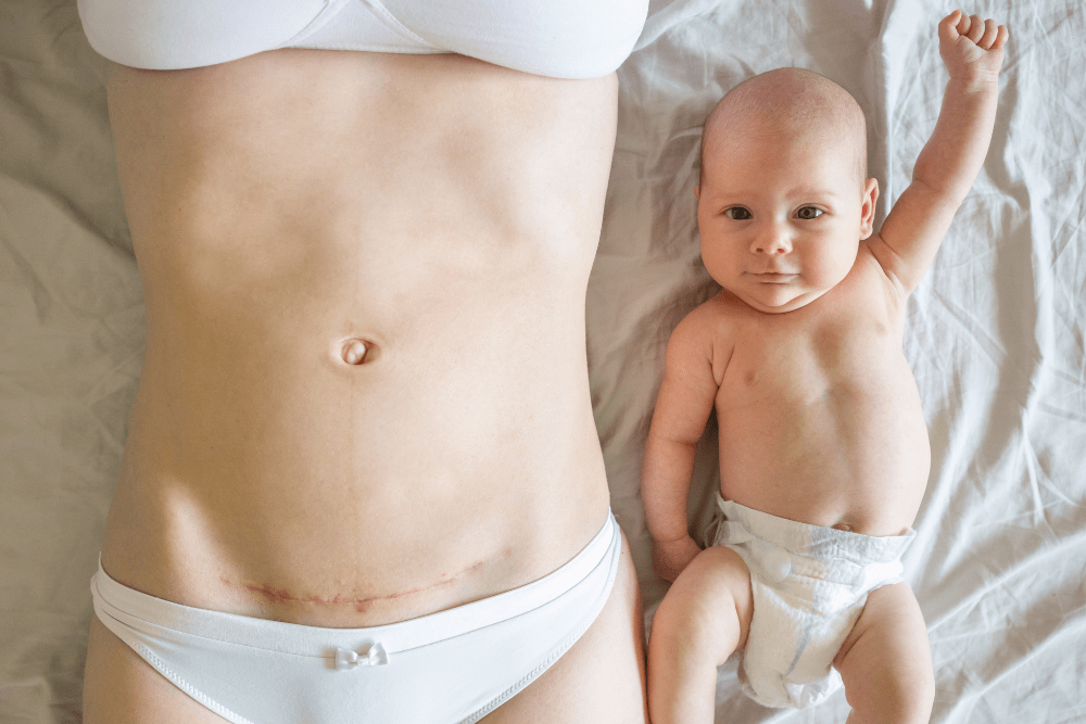 caesareans-linked-to-increased-infertility