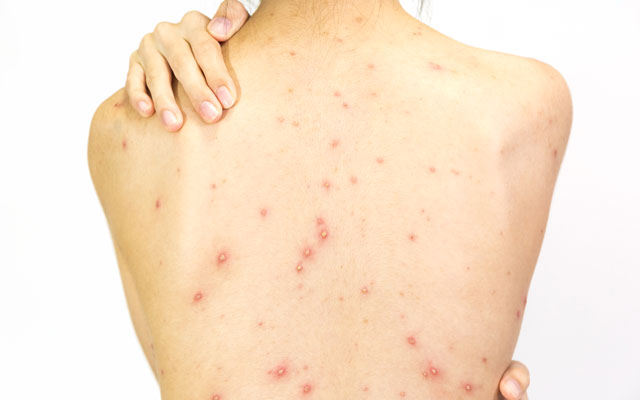 Chicken pox can you get it twice