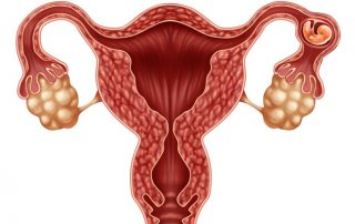 Ectopic pregnancy