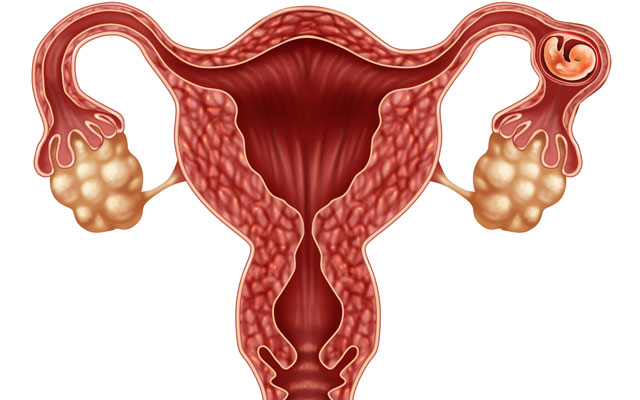 Ectopic pregnancy