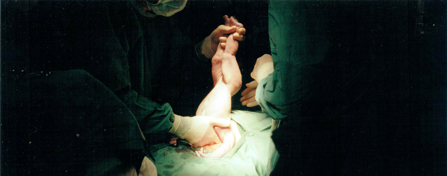 Term breech trial
