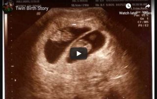 Twin Birth Story