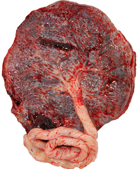 Placenta Praevia