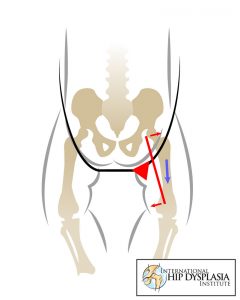 Hip dysplasia