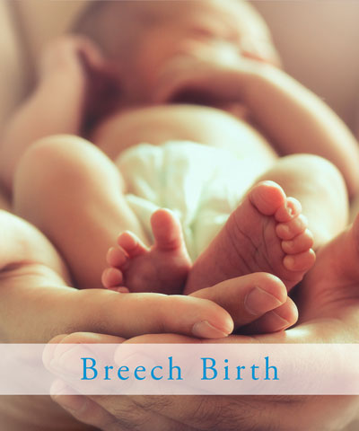 breech birth