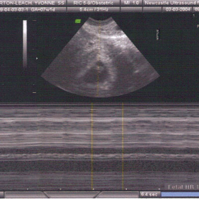 The first time I met you on an ultrasound screen
