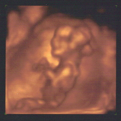 The first time I meet You Ultrasound