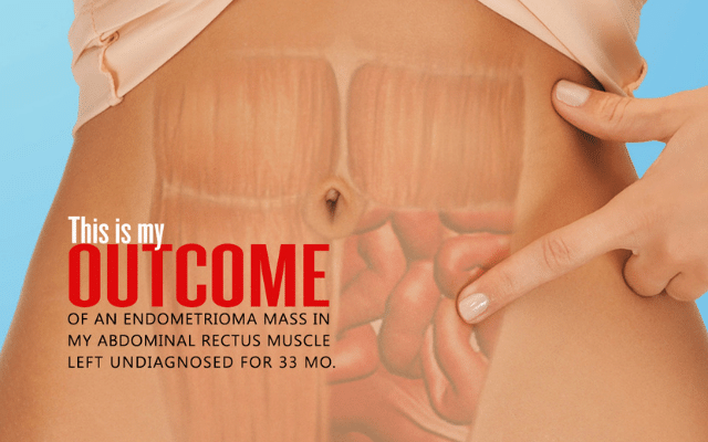 Iatrogenic Endometriosis a Cesarean Risk