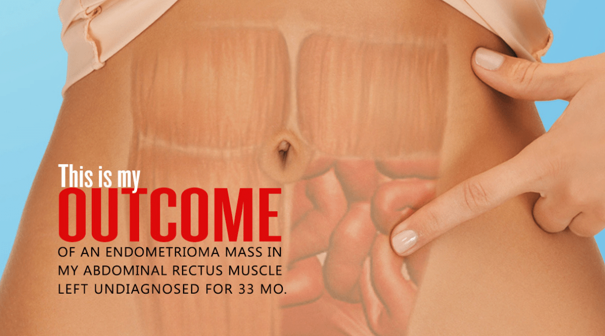 Iatrogenic Endometriosis a Cesarean Risk