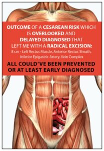 Iatrogenic Endometriosis a Cesarean Risk